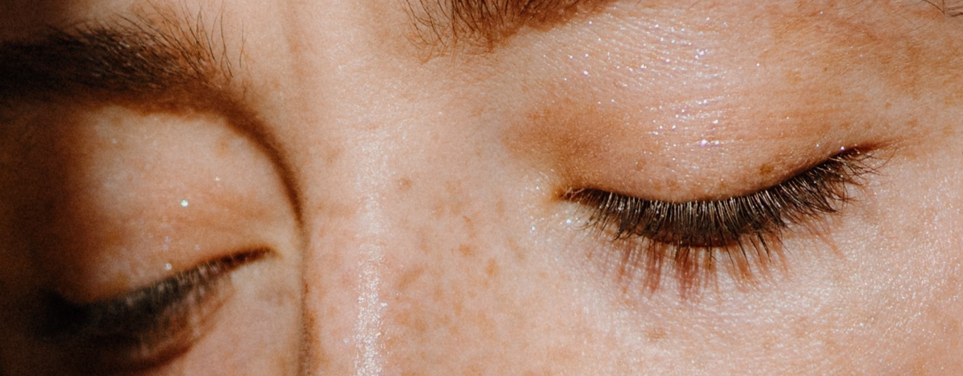 A napégette arcbőr kezelési lehetőségei